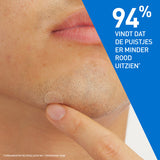 CeraVe Anti-Puistjes Patches - 22 patches - CeraVe - Huidproducten.nl